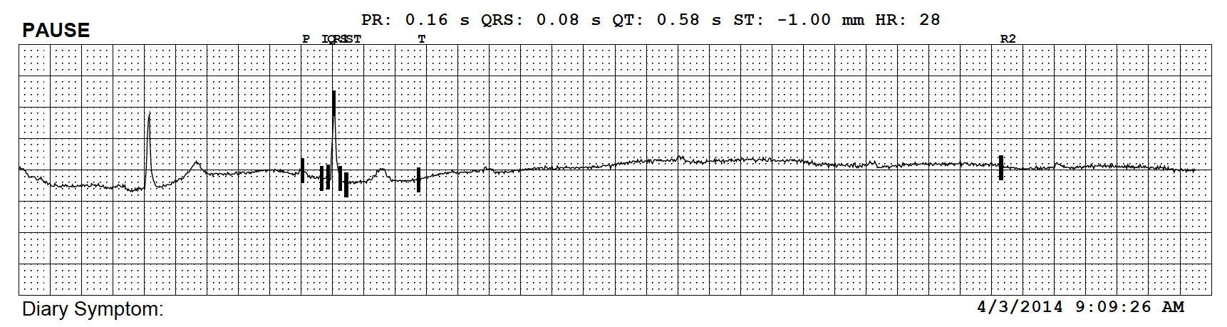 EKG Printout