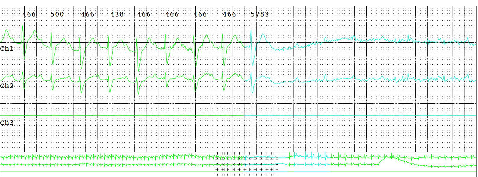 EKG Printout