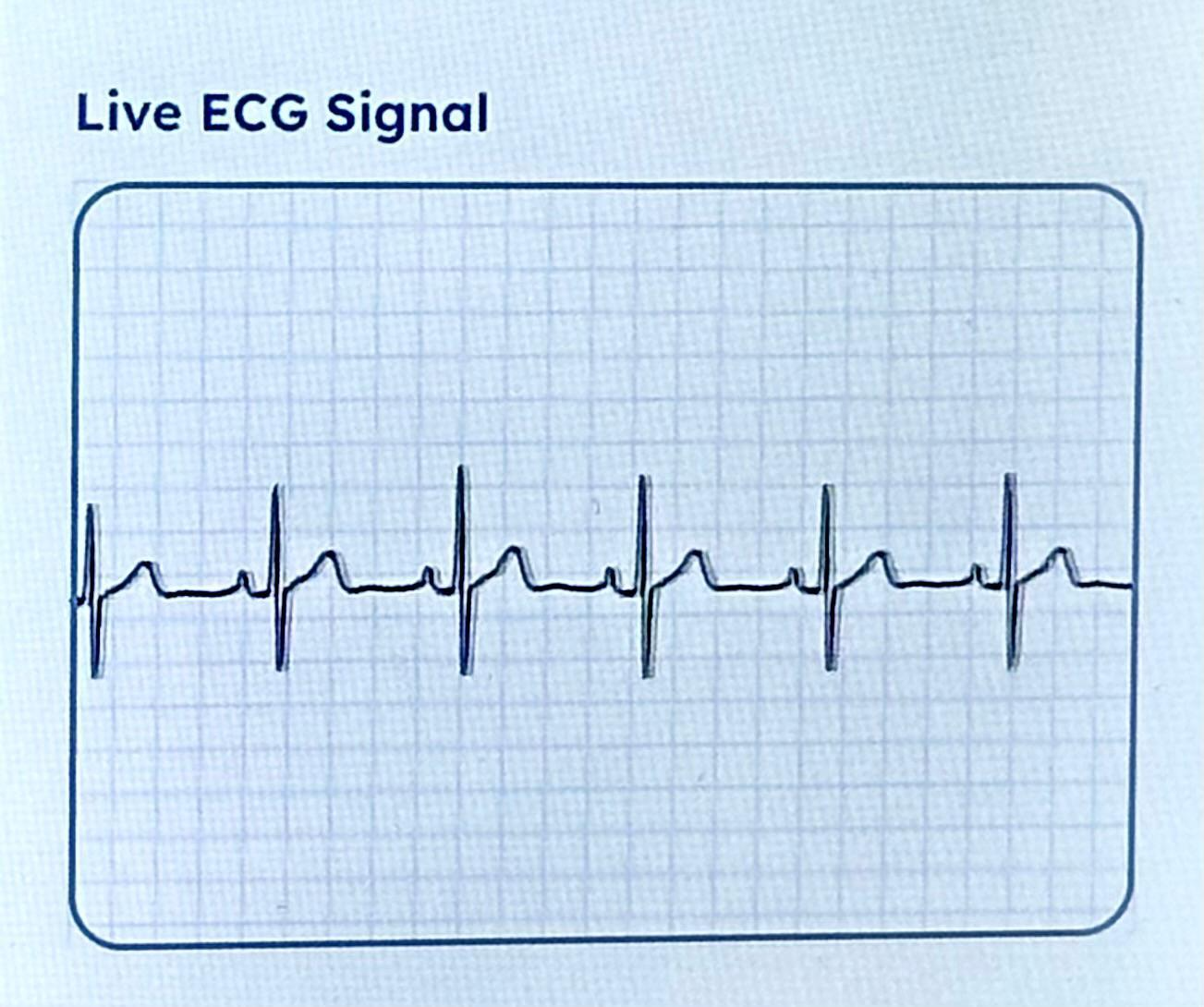 Live ECG waveform display